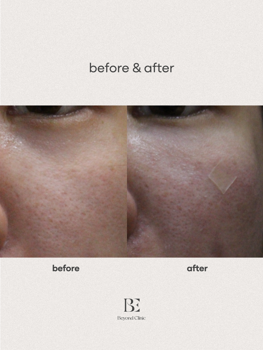 under-eye filler