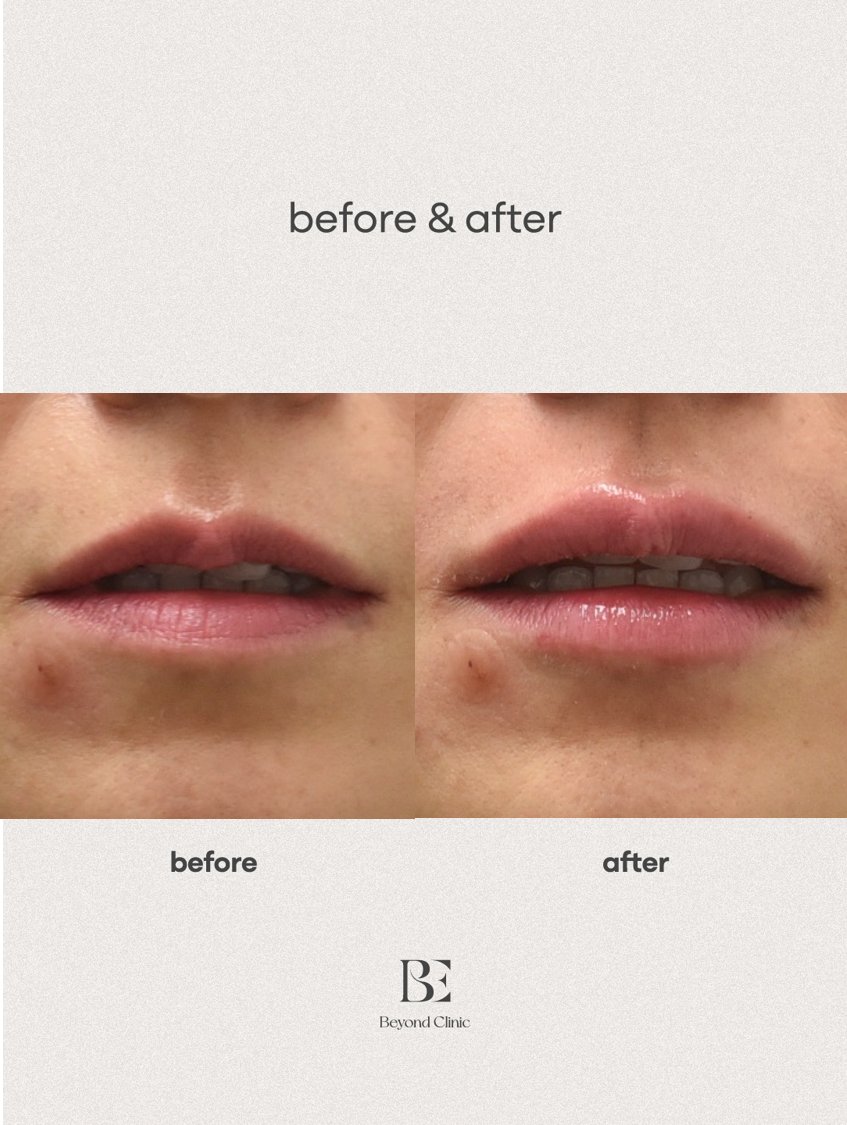 Lip filler