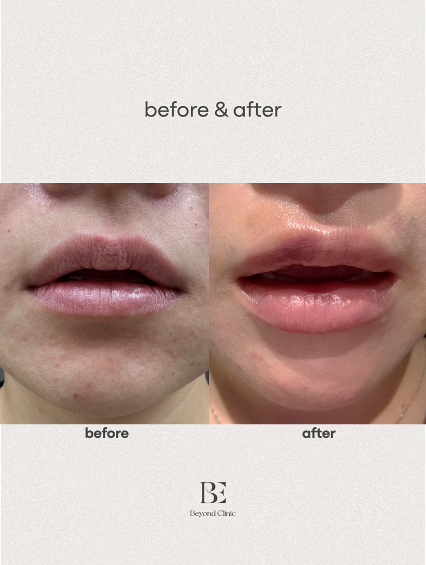 Lip filler