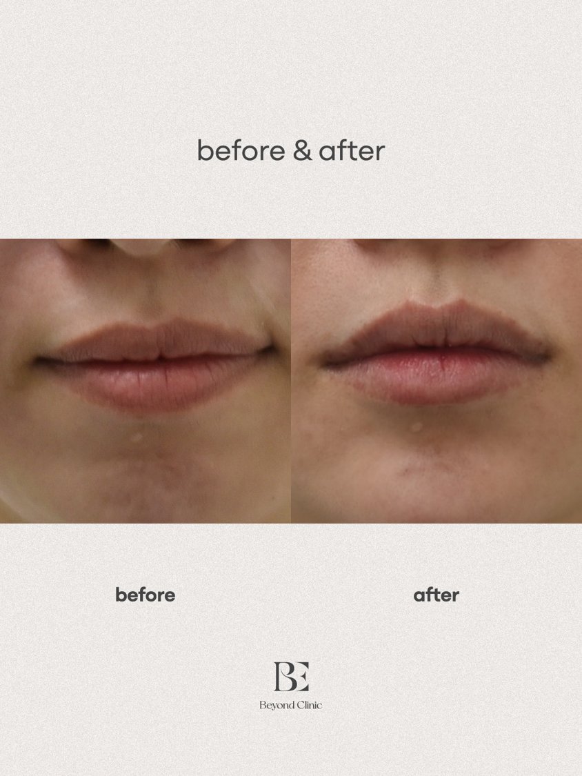 Lip filler