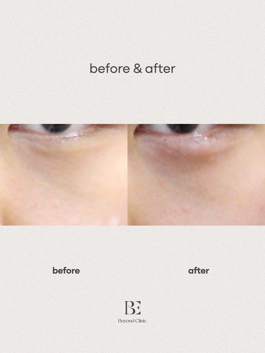 under-eye filler