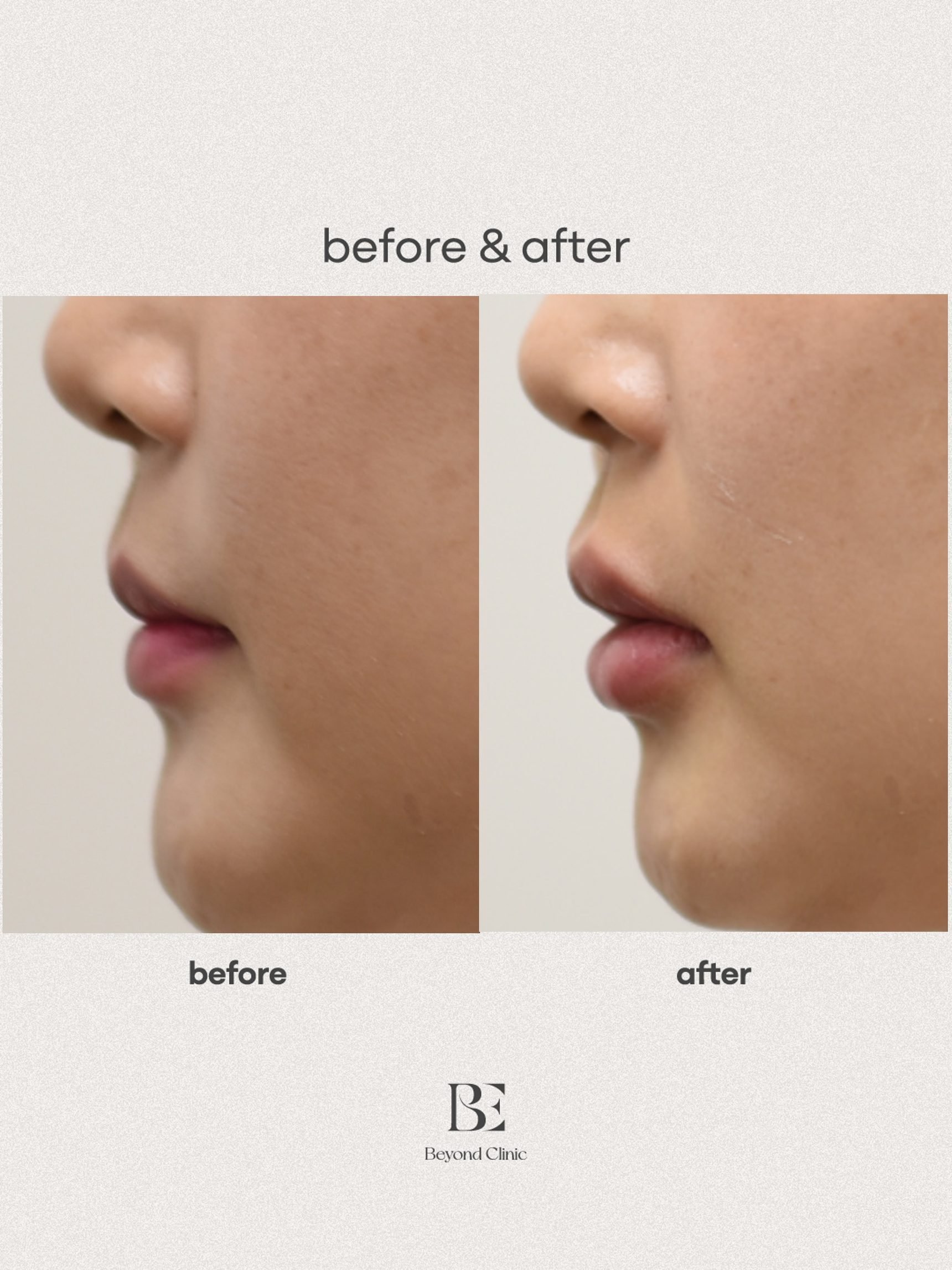 Lip filler